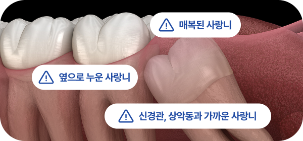 사랑니발치