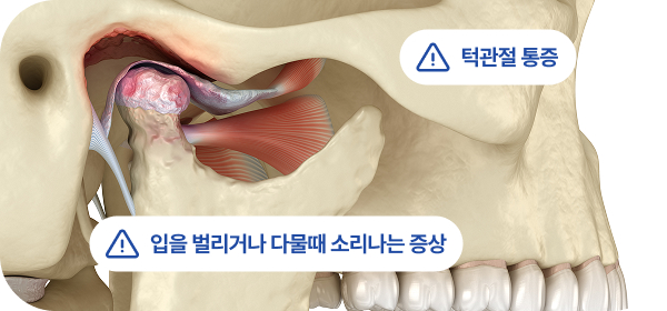 턱관절케어